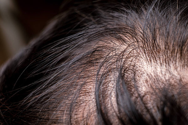 Diffuser Haarausfall (Alopecia diffusa) - Alles was du wissen musst!